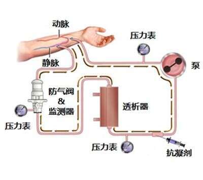 日本干细胞治疗|尿毒症治疗3+1种方法