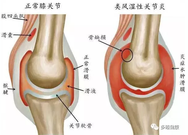 5年肝硬化患者第二意见问诊故事