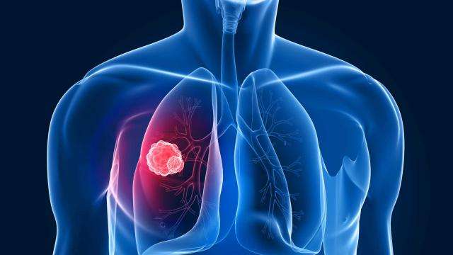 肺癌防治-日本体检与多睦健康