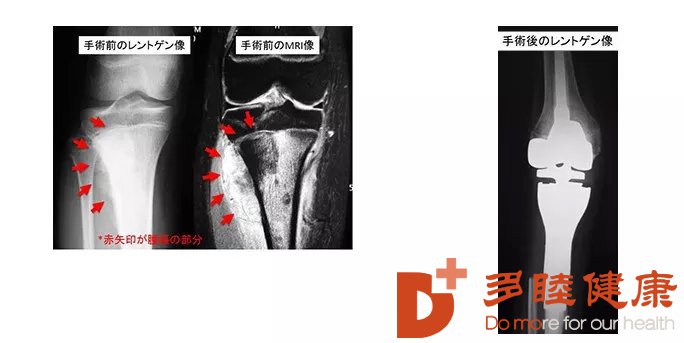 图注：日本顺天堂医院骨肉瘤手术改善前后对比展示图（图片来源顺天堂医院官网）