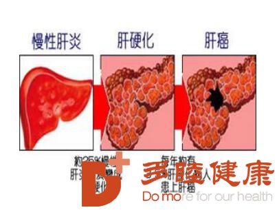 抓住肝硬化可逆期，抓住生命的希望！