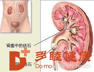 多睦健康|肾结石的危害你知道吗？