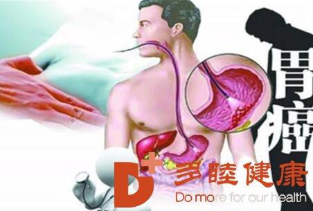 癌研有明|有了这些信号，要小心胃癌找上门！