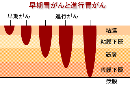 专家告诉你：早期筛查是预防胃肠道肿瘤的关键