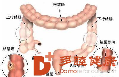 癌研有明-饮食习惯与肠癌关系还是很密切的