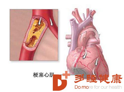 榊原医院-心肌梗塞饮食安排要合理用药须牢记四禁忌