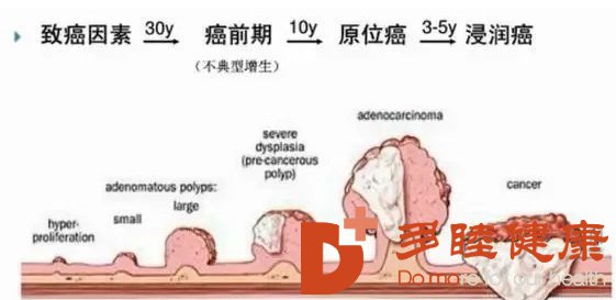 癌研有明-肠癌的隐匿杀手，有效根治大肠息肉