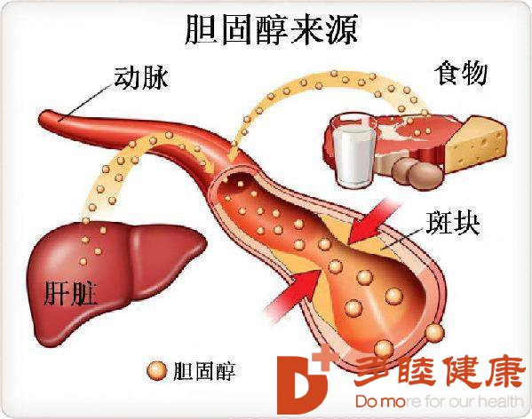 血液净化：你的血液有多脏——胆固醇结晶