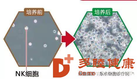 高龄晚期癌症治疗完全缓解，这种细胞让抗癌威力大增！