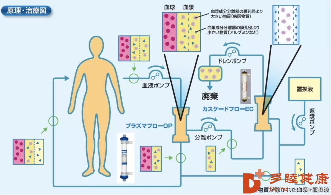 療法 血漿 交換