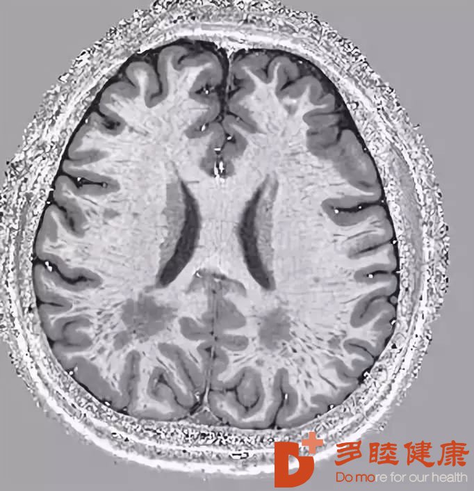 脑缺血的血液透析患者：透析中血压高一点还是低一点好？