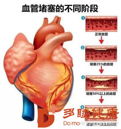 血液净化：才35岁就要做支架，但血管已经70岁了