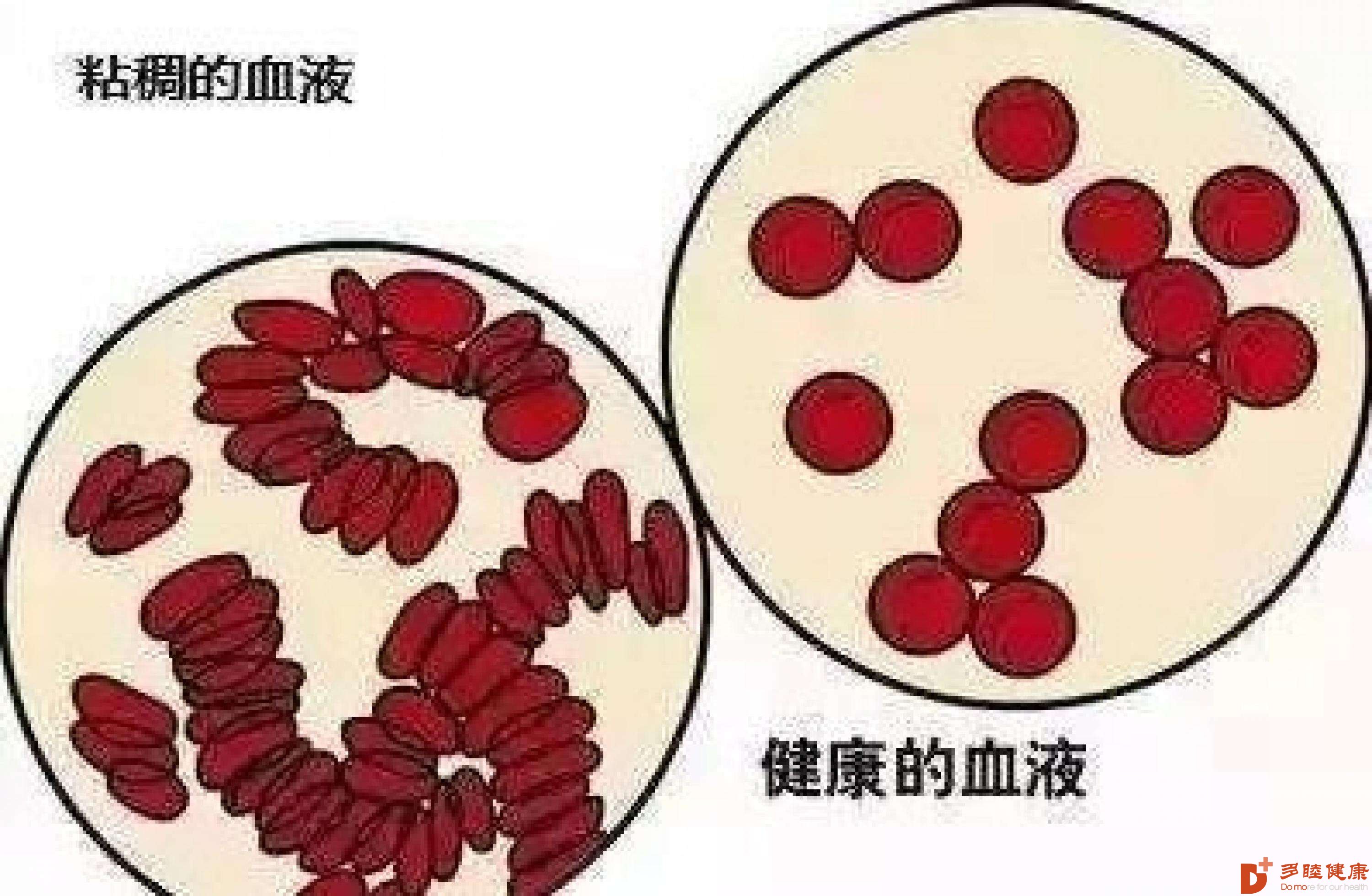 血液净化:血液粘稠是什么病?和高血压有关?