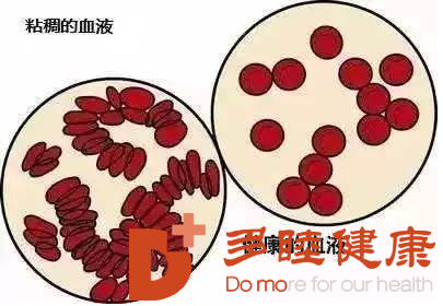 血液净化：以为很健康其实，你的血液早已“粘稠如粥”