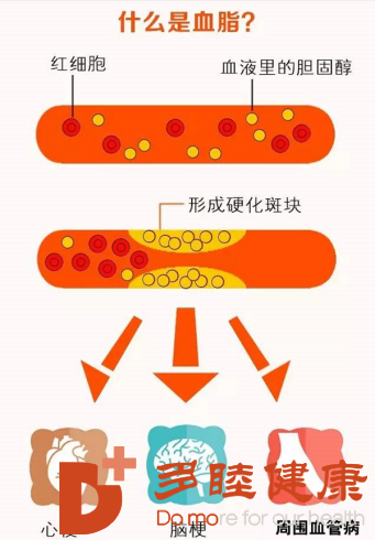 日本血液净化：瘦的人也会得高血脂吗？想降脂先搞清楚诱因