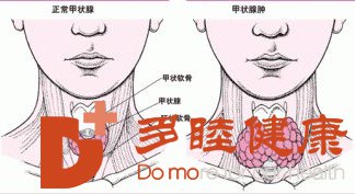 日本看病：促甲状腺激素偏高的原因有哪些？