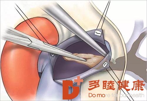日本血液净化：肺动脉栓塞的病因有哪些？