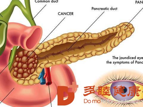 日本看病：胰腺癌的早期症状表现是什么?