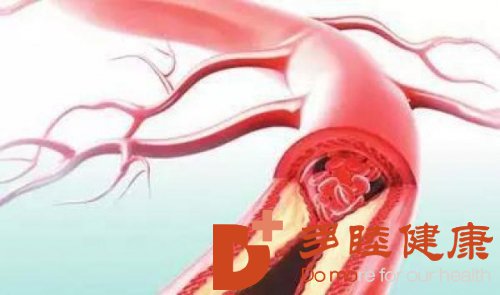 日本血液净化：血管硬化怎么办？