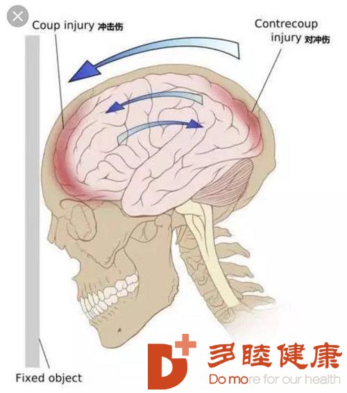 日本看病：“脑震荡”会留下后遗症吗？