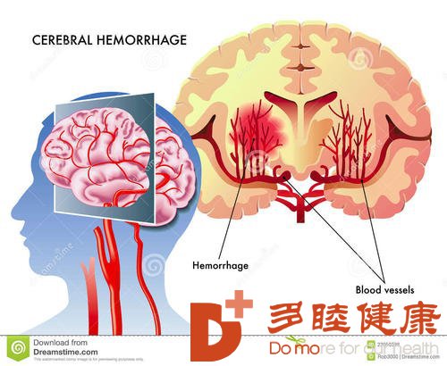 日本干细胞：脑出血(脑溢血)形成原因是有哪些