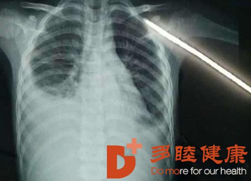 日本看病：胸腔积液早期症状是什么样的