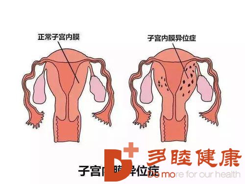 日本看病：子宫内膜异位症的症状有哪些