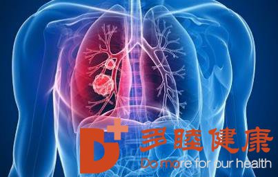 日本看病：去日本找名医做肺癌手术！