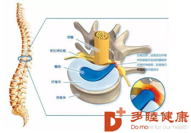 干细胞疗法是如何修复改善椎间盘退变的？