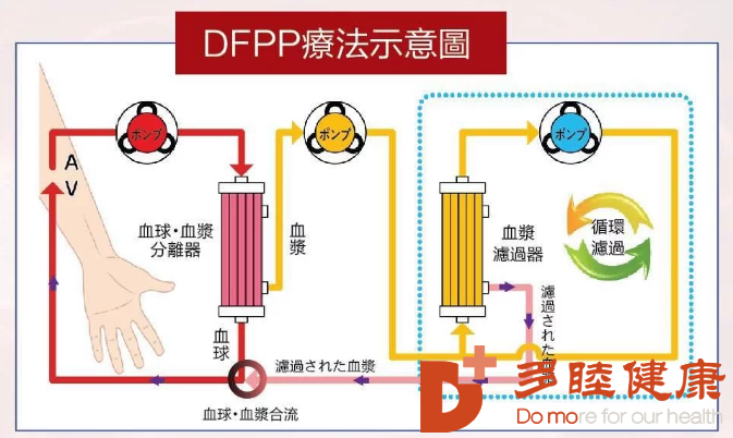 DFPP疗法新鲜的地方到底在哪里,作用怎么样？