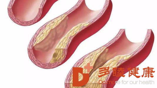 日本血液净化：动脉硬化的原因 怎样预防动脉硬化
