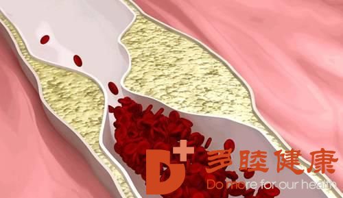 日本血液净化：重视心梗发作的早期症状 心肌梗塞的生活指导