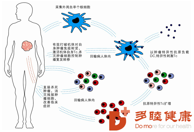 日本免疫疗法：激活自身免疫，解读DC细胞疗法