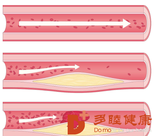 日本血液净化：高血压糖尿病易发动脉硬化