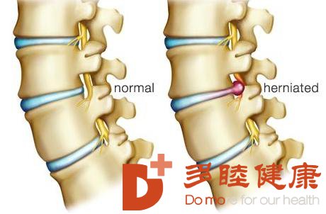 日本看病：20年腰间盘突出三小时出院