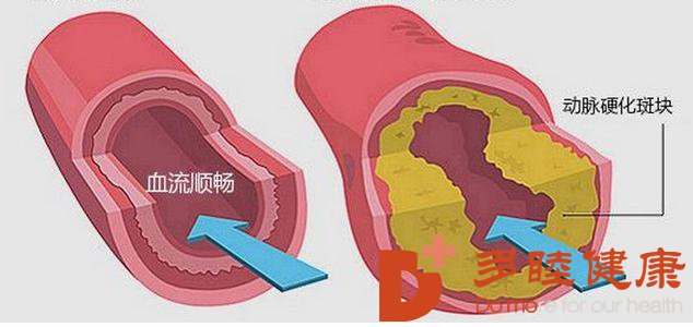 日本血液净化：详解“动脉硬化”的来龙去脉