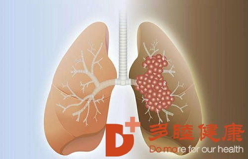 日本看病：肺癌出现这10大症状要尽快去检查