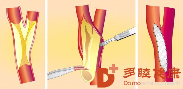 日本血液净化：如何应对颈动脉狭窄预防脑卒中？