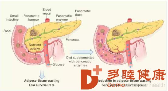 山西海外医疗：这些胰腺癌护理的知识 你知道多少？