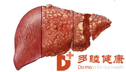 日本看病：如何检查自己是否患上肝癌?