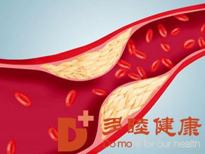 日本血液净化：动脉硬化原因的发病原因有哪些