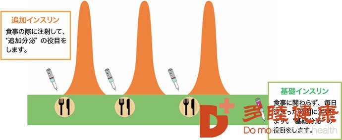 日本如何治疗1型糖尿病