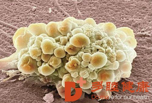 日本在胶质母细胞瘤方面的治疗方法