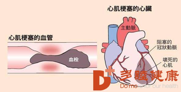 日本血液净化：心梗发病不分年龄 警惕心梗注意三点