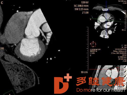 冠脉CTA和冠脉造影哪个检查更好？
