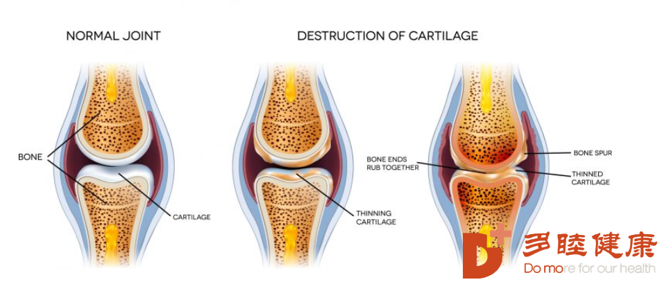日本干细胞-干细胞在治疗骨关节炎未来可期