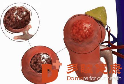 日本免疫疗法-nk细胞免疫疗法能不能治疗肾癌？