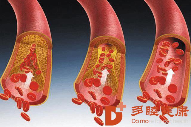 日本血液净化-心肌梗塞的发病会与什么有关