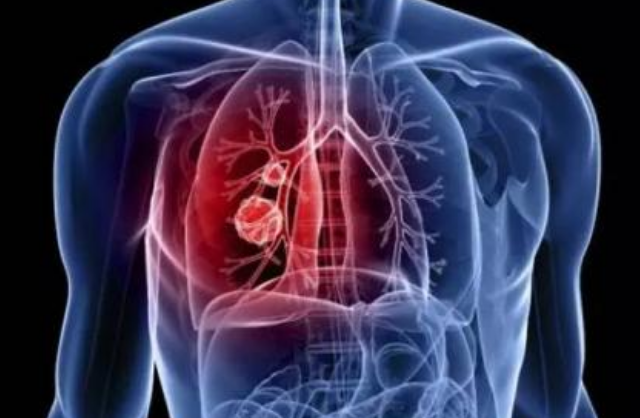 预防肺癌，还要多关注肺外的症状表现
