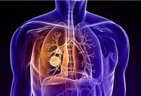 “最爱非吸烟患者的肺癌”——肺腺癌